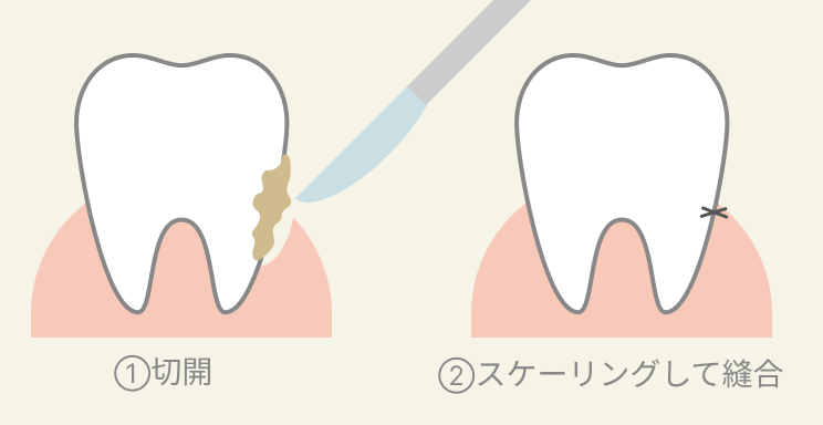 フラップ手術